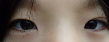 Upslanting palpebral fissures, a suggestion of epicanthal folds, and a flat nasal bridge. Pseudostrabismus Wikipedia