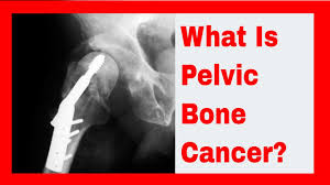 Because the cancer has spread, it is considered advanced or stage 4 cancer. Pelvic Bone Cancer Bone Cancer Symptoms Youtube