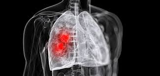 If the cancer spreads ( metastasizes) beyond the lungs to other body parts and organs, other symptoms may arise. Osimertinib Improves Symptoms In Advanced Lung Cancer Patients