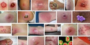 Mrsa germs can get into a skin injury, such as a cut, bite, burn or scrape. Mrsa Antibiotic Resistant Bacteria Explained Antibiotic Research Uk