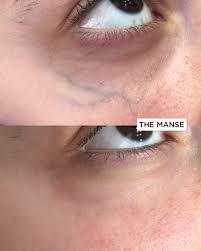 Concealer is the only 100% guaranteed way to get rid of dark circles, at least until you wash it off at night. Blue Vein Removal Best Clinic For Facial Vein Removal Sydney
