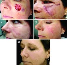 Scars before after pictures provided by q esthetics laser clinic, contact to see more amazing before after photos of laser scar removal treatment. Laser Resurfacing Can Effectively Minimize Post Surgery Scars Mdedge Dermatology