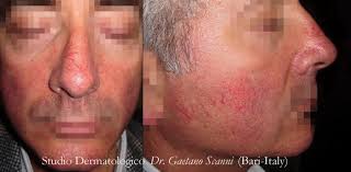 Caratterizzata da papule e pustole simili all'acne giovanile, la rosacea è una patologia dermatologica che è bene trattare fin dagli esordi. Rosacea Dr Gaetano Scanni
