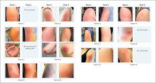 Apr 21, 2021 · during the first month of vaccine administration in the u.s., 61 per cent of the doses were given to women, but 72 per cent of the side effects were reported by them, according to the u.s. Physicians Warn Of Delayed Skin Reactions To Covid Vaccine With Images Clinical Daily News Mcknight S Long Term Care News