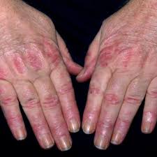 Image result for Dermatomyositis