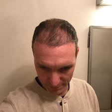 It's a type of surgery that moves hair you already have to fill an area with thin or no hair. Stages Of Hair Transplant Growth See This Patient S Hair Grow After A Transplant