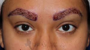 As the procedure of eyebrow transplant grow in popularity, it is evident that there has never been a period in time where eyebrows were of so much value in terms of fashion as in this era. Eyebrow Transplant Frisco Tx Add Eyebrow Hair Dallas