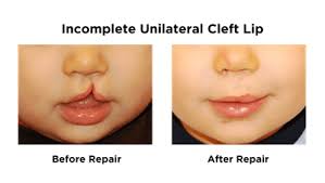 Image result for Cleft Lip