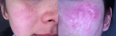 Rotina De Beleza Para Pele Com Rosacea Pretty Exquisite