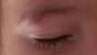 Eyebrow Hair Stuck Under Skin