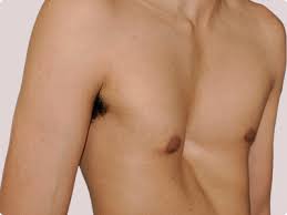 Maybe you would like to learn more about one of these? Pectus Excavatum India Pdf Ppt Case Reports Symptoms Treatment