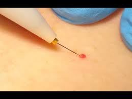 See all home microneedling products. Milia Extraction Cherry Angioma Removal With Electrolysis Youtube