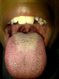 Image result for brown tongue symptoms