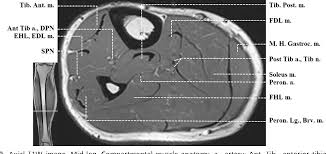 Anterior graphic of the shoulder. Normal Mr Imaging Anatomy Of The Thigh And Leg Semantic Scholar