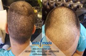 زراعة الشعر بالرياض