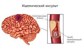 Chto Takoe Insult Chem Opasen I Chto Vazhno O Nem Znat Gorodskaya Poliklinika 2 G Vladimira