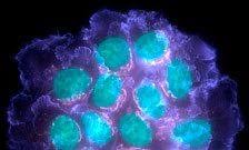 The types of biopsies performed may include an incisional. Throat Cancer Gene Uncovered Guy S And St Thomas Nhs Foundation Trust