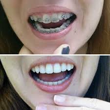 114 Incredible Before After Transformations Of People Who Wore Braces In 2020 Braces Transformation Beautiful Teeth Perfect Teeth