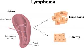 Head and neck cancer can cause pain or a burning sensation when chewing and swallowing food. Lymphoma Symptoms What You Need To Know First Signs Of Lymphoma