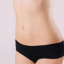 Elevated hormones at the time of pregnancy further increases the susceptibility of the dermis to tear. Laser Scar Stretch Mark Treatment Utah Utah Valley Dermatology