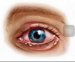 Op Dr Lutfiye Yaprak Goz Hastaliklari Uzmani Uveit Nedir Goz Yuvarlaginin Ortasinda Bulunan Jel Benzeri Maddenin Cevresini 3 Tabakadan Olusan Bir Kilif Sarar Ortadaki Tabaka Uvea Dir Uveanin Iltihabina Uveit Denir Uveit Gozun Uvea Adini