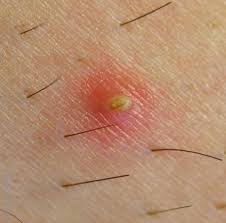 Ingrown hairs are a result of hair removal gone awry. Is It Herpes Or Ingrown Hair New Health Guide