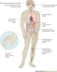 Lupus doesn't directly affect the heart, but the inflammation the. Systemic Lupus Erythematosus Nature Reviews Disease Primers
