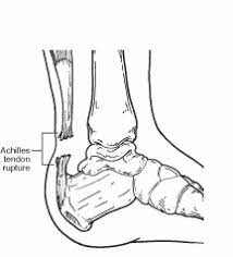 Learn the basics of achilles tendon. Achilles Tendon Rupture Foot Health Facts
