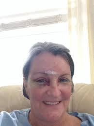 Did Not Have Side or Top Vision, It Was Like Tunnel Vision