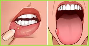 In order to remove all the deposits from. 16 Home Remedies To Get Rid Of Blisters On The Tongue Causes And Prevention Tips