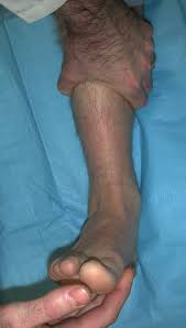 Image result for Ankle External Rotation Test