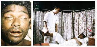 Diagnosis of Snakebite and the Importance of Immunological Tests in Venom  Research