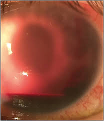 Image result for Hyphema