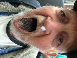 Image result for black hairy tongue symptoms