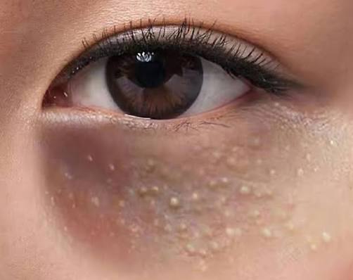 Milia Seeds: Causes, Treatments, and Why The Brow and Beauty Boutique Is  Your Ultimate Solution &mdash; Singapore best eyebrow embroidery eyeliner lip  misty eyebrow microblading 6D eyebrow