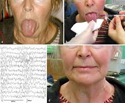 Behandlung lingualer Dystonie mit Botulinum-Toxin-Injektionen