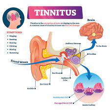Unterschiede Zwischen Horsturz Und Tinnitus