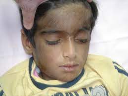Excessive excessive hair growth, also known as hirsutism, is one of the most emotional symptoms of pcos. Excessive Hair Growth Including Forehead Malar Area With Download Scientific Diagram