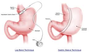 gastric sleeve vs gastric band gastric sleeve