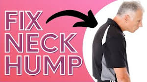 You can also develop this condition due to a trauma, or scheuermann's disease. How You Can Get Rid Of Neck Hump With A Sock Dowager S Hump Youtube