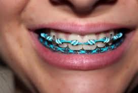 Black And Light Blue Braces This Is The Color I Want My Braces Light Blue Braces Colors Braces Bands Teeth Braces