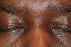 Image result for xanthelasma of eyelid