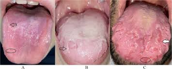 Image result for Fissured tongue