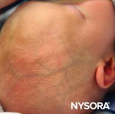 Image result for Difficult Intravenous Access in Children