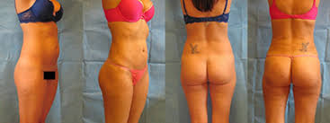 When you get skinny jeans, and they're too big. Skinny Brazilian Butt Lift Tampa Bbl For Thin People Tampa Bay Fl
