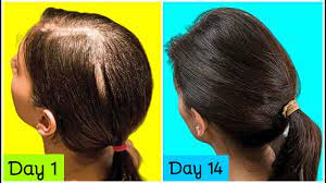 Just 2 Weeks Grow Extremely Long Hair Thicker Hair Healthy Hair Stop Hair Loss Hair Fall Youtube Severe Hair Loss Thick Hair Styles Stop Hair Loss
