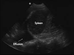 In patients with bilateral pleural effusion. Ultrasound Findings Of Plasma Leakage In Dengue Fever In The American Journal Of Tropical Medicine And Hygiene Volume 99 Issue 6 2018