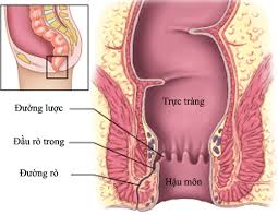 U trực tràng lành tính là một loại u xuất hiện trên bề mặt niêm mạc trong đại tràng. Ro Trá»±c Trang Am Ä'áº¡o Ro Háº­u Mon Am Ä'áº¡o Tháº§y Thuá»'c Viá»‡t Nam