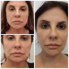 We did not find results for: Jowl Lift Treatment Thread Lift For Jowls London Harley St Lorena Oberg