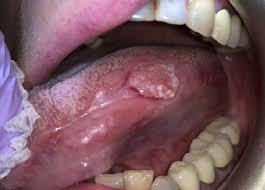 Image result for spinocellular carcinoma of the oral cavity